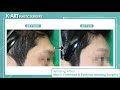 man's forehead surgery_brow bone reduction before and after