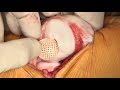 Viable Osteochondral Allograft for the Treatment of a Full-Thickness Cartilage Defect of the Patella