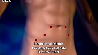 Robotic Prostatectomy Overview - Dr. Sanjay Razdan