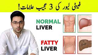 Dr. Zee:3 Weird Signs \u0026 Symptoms Of Fatty Liver | डॉक्टर ज़ी