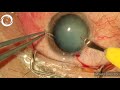 phaco in a traumatic cataract