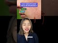 pakai ini saat beruntusan skincaretips aestheticdoctor bruntusan