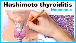 Hashimoto thyroiditis Mnemonic