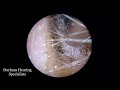 white fungus growing in ear canal and on ear wax fungal infection aka otomycosis