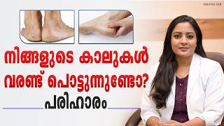 നിങ്ങളുടെ കാലുകൾ വരണ്ട് പൊട്ടുന്നുണ്ടോ Foot care Tips for Cracked Heels | How to Treat Cracked Heels