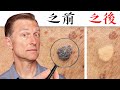 【皮膚】一天快速消除瘜肉和肉疣自然療法,柏格醫生 Dr Berg