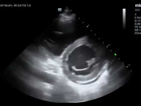 Severe Lv Systolic Dysfunction Youtube