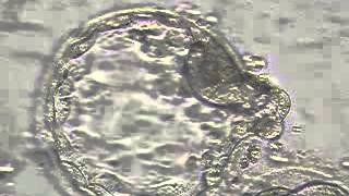 Embryo transfer with Spontaneously hatched Blastocyst at Ideal Fertility Clinic