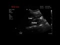 case uterine rupture