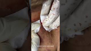 Big Cystic Acne Blackheads Extraction Blackheads \u0026 Milia, Whiteheads Removal Pimple Popping #shorts