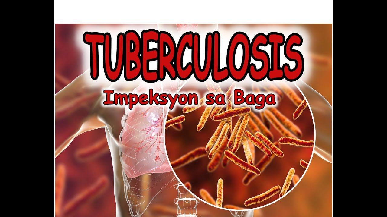 TUBERCULOSIS: Tuberculosis O Impeksyon Sa Baga - YouTube