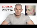 Rosacea, the liberating root cause revealed.