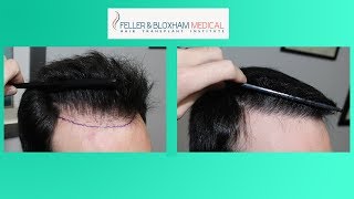 Hairline Repair after Hair Transplant \