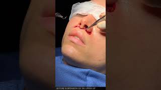 The Subnasal lip lift, Bullhorn lip lift, Upper lip lift by Dr. Anurag Agarwal