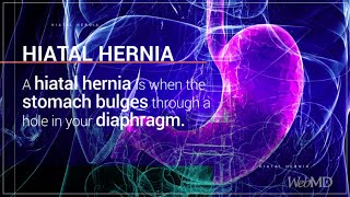 The Basics: Hiatal Hernia | WebMD