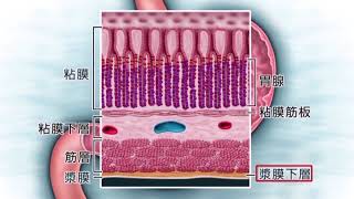 【ダイジェスト版】臨床看護技術シリーズ　第7巻「胃がんとは」