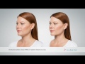 kybella double chin fat reduction reduction commercial