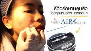 รักษาหลุมสิวด้วย “Air Dissector” โดย “คุณหมอ” 👩‍⚕  [L Clinic Beauty Center]