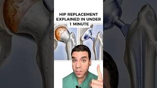 Hip Replacement explained in less than 1 minute!