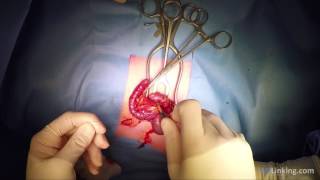 Appendectomy (open procedure)