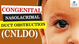 Congenital Nasolacrimal Duct Obstruction | Dr. Rwituja | CNLDO