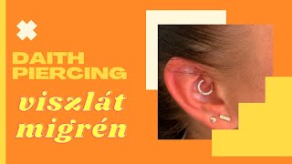 Daith/migrén piercing szúrás