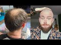 BUZZ CUT vs HIDING MY BALDING/THINNING CROWN TRANSFORMATION