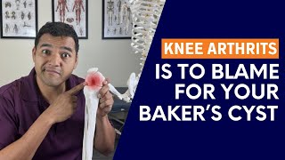 The Hidden Link Between Knee Arthritis and Baker's Cyst