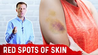 What Causes Bruises on Legs \u0026 Arms? – Top 5 Causes of Bruising Covered by Dr.Berg