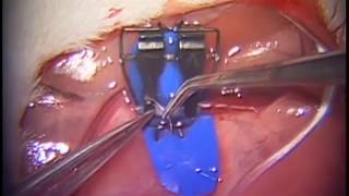 The One Way Up Technique of Microvascular Anastomosis .