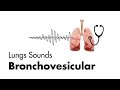 Bronchovesicular Breath Sounds - Lung Sounds - MEDZCOOL