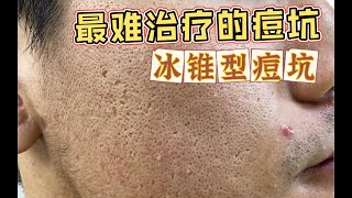 冰锥型痘坑为何是最难修复的类型，冰锥痘坑做了三次后的恢复情况