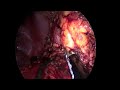 transvaginal nephrectomy hilar dissection