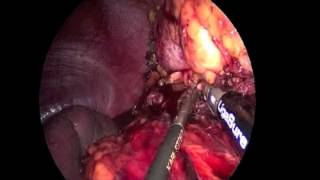 Transvaginal nephrectomy - Hilar dissection