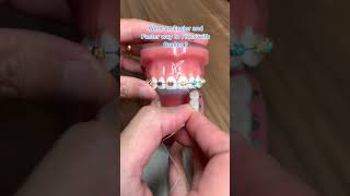 Easier Way to Floss with Braces | Platypus Floss