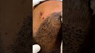 🚀28M+ Views | It’s not just a regular head wash 🚿| Hair Transplant Clinic in Del