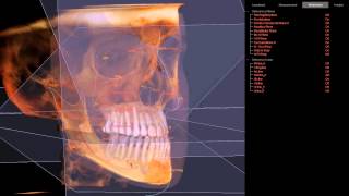 3D Cephalometric Analysis