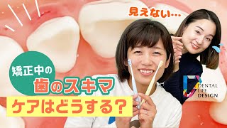 【矯正中に生じたコンタクトの隙間のプラークコントロールについて教えてください】今更聞けない歯科知識 新人歯科衛生士さんのためのお悩み相談室/萬田久美子先生