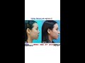 ksamsung tv global ks rhinoplasty bent nose hooked nose 鼻子整形 歪鼻子 鼻子修复手术 做完鼻子后的改变 鼻子 曲った鼻整形 小鼻整形