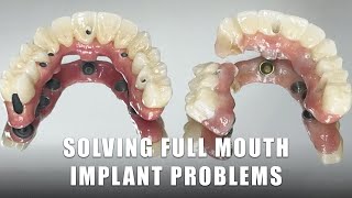 Solving Full Mouth Implant Problems