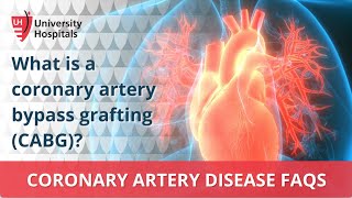 What is a coronary artery bypass grafting (CABG)?