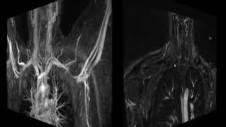 Thoracic Outlet Syndrome MRA MRV