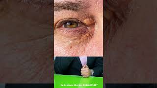 आंखो के कोलेस्ट्रॉल से छुटकारा, Xanthelasma , Eye Cholesterol Home Remedies , Eye Cholesterol remove