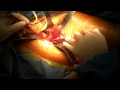 Anterior Hip Replacement by Erik N. Zeegen, MD. (Los Angeles, CA)