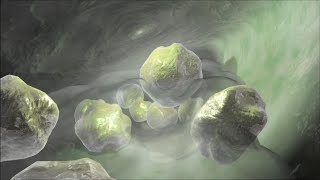 Gallbladder Surgery for Gallstones