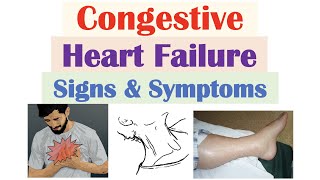 Congestive Heart Failure Signs & Symptoms (& Why They Occur)