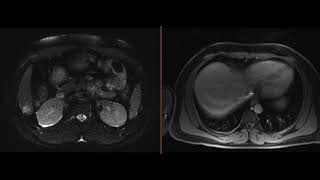 Hepatic abscess with hepatic vein thrombus