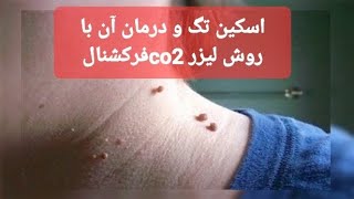 برداشتن خال گوشتی| اسکین تگ یا منگوله پوستی