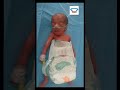 The six months old premature baby was resuscitated for twenty minutes