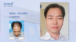 頭頂稀疏加密效果曝光，植髮帶來的改變讓人驚訝！Yonghe hair transplant